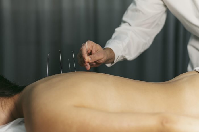 Registered Acupuncturist performing acupuncture treatment